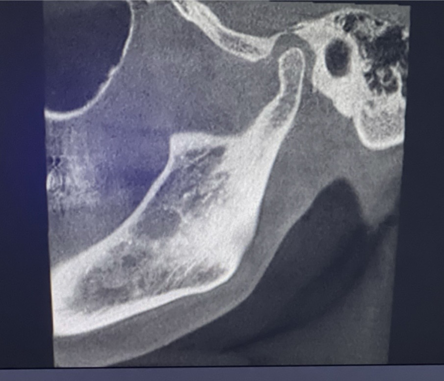 Przekrój tomograficzny CBCT stawu skroniowo-żuchwowego